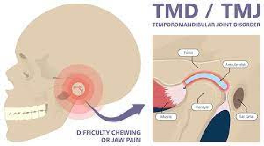 TMD/TMJ Treatment